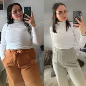 Avant-après bypass gastrique Roux-en-Y à Memorial Ankara Hospital, perte de poids visible