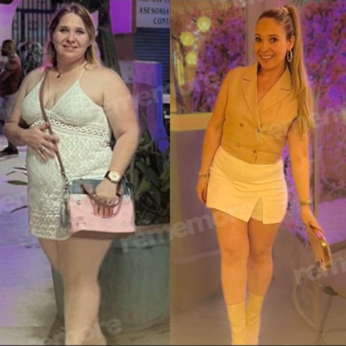 Antes y después de bypass gástrico Roux-en-Y en Memorial Ankara Hospital, resultado visible