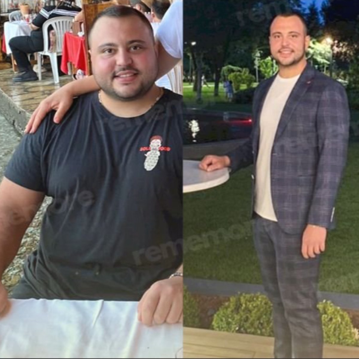 Antes y después de bypass gástrico Roux-en-Y en Memorial Ankara Hospital, resultado visible de pérdida de peso
