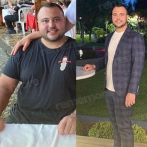 Результаты до и после метаболической хирургии в Memorial Ankara Hospital – значительная потеря веса