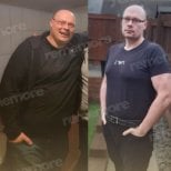 Before and after metabolic surgery at Memorial Ankara Hospital, significant weight loss result