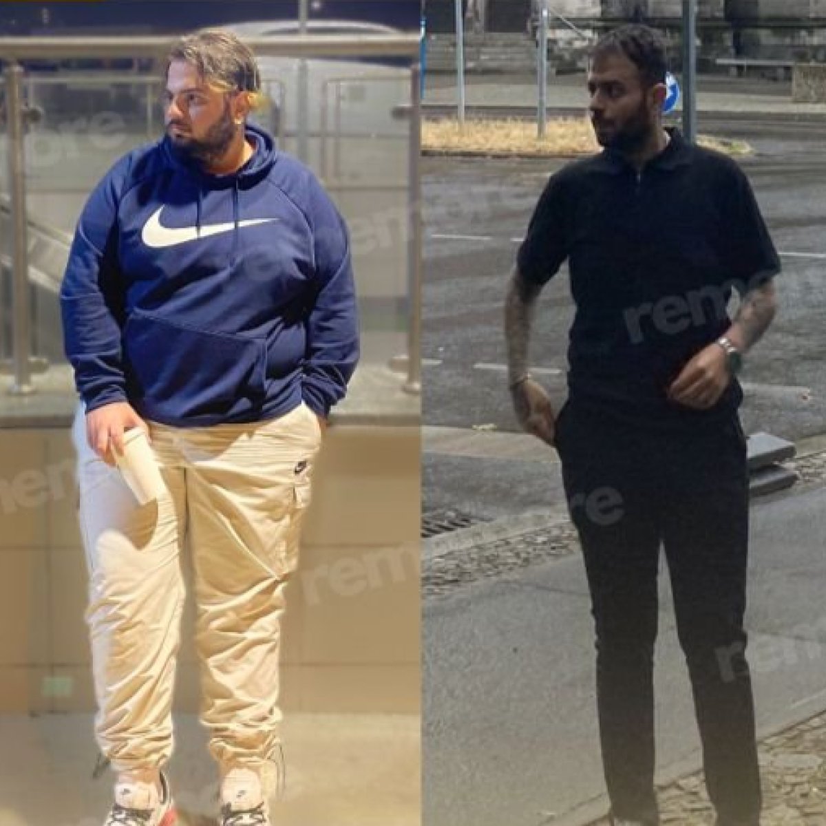 Before and after metabolic surgery at Memorial Ankara Hospital – visible weight loss results