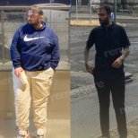 Before and after metabolic surgery at Memorial Ankara Hospital – visible weight loss results