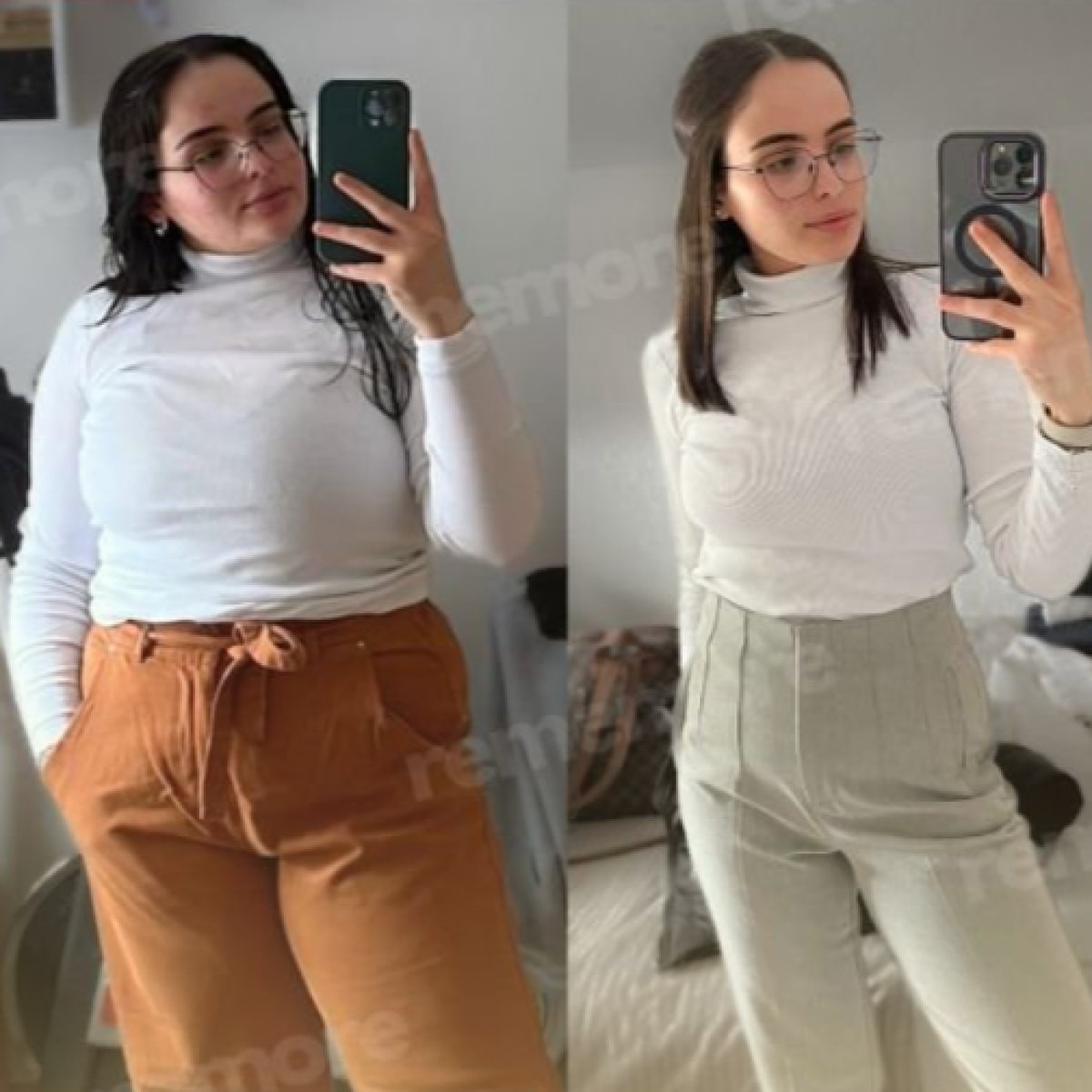 Before and after metabolic surgery at Memorial Ankara Hospital, visible weight loss result