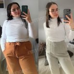 Before and after metabolic surgery at Memorial Ankara Hospital, visible weight loss result