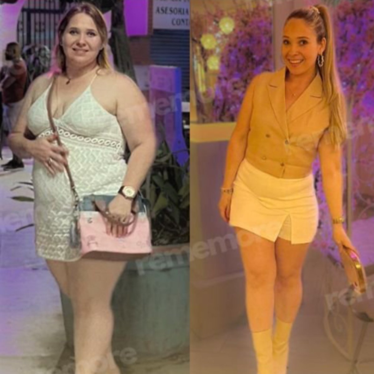 Before and after metabolic surgery at Memorial Ankara Hospital, visible weight loss result