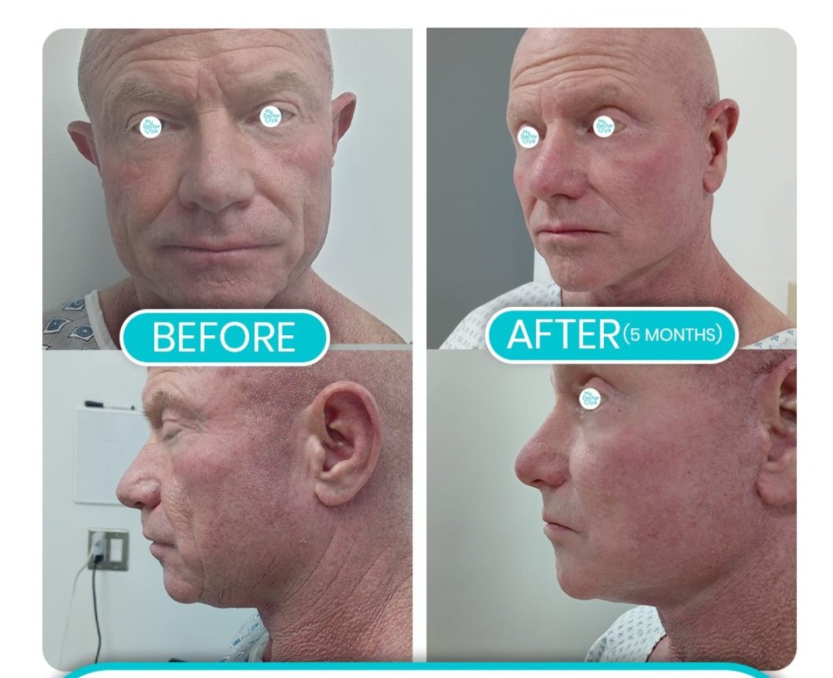 Neck lift results – before and after at Hospital de la Familia