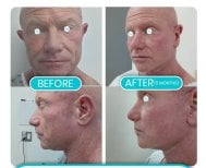 Результаты подтяжки лица до и после в Hospital de la Familia, омоложение за 5 месяцев