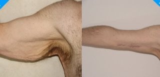 Resultados antes y después de braquioplastia en Clinica Granado Tiagonce, mejor contorno