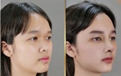Before and after open rhinoplasty results at Kongju Clinic, nose reshaping with natural look