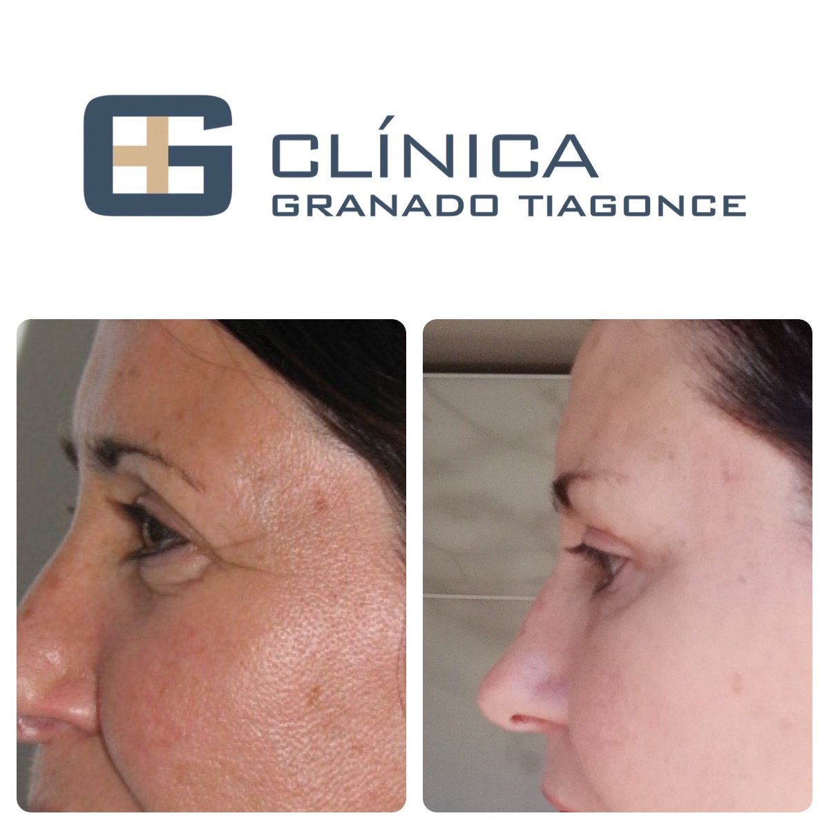 Resultados de blefaroplastia superior antes y después en Clinica Granado Tiagonce, ojos rejuvenecidos