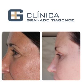 Before and after upper eyelid surgery results at Clinica Granado Tiagonce, rejuvenated eyes