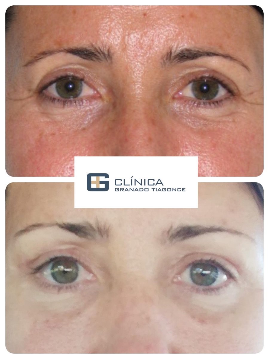 Resultados de blefaroplastia superior antes y después en Clinica Granado Tiagonce, ojos rejuvenecidos