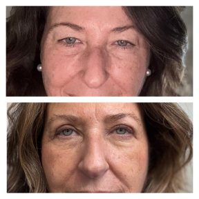 Before and after upper eyelid surgery results at Clinica Granado Tiagonce, rejuvenated eyes