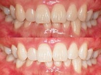 Before and after tooth whitening results at Yonsei JW Dental Clinic, visibly brighter smile