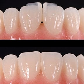 Before and after no prep veneers result at Yonsei JW Dental Clinic, improved front teeth