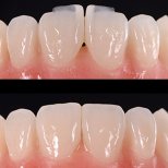 Before and after no prep veneers result at Yonsei JW Dental Clinic, improved front teeth