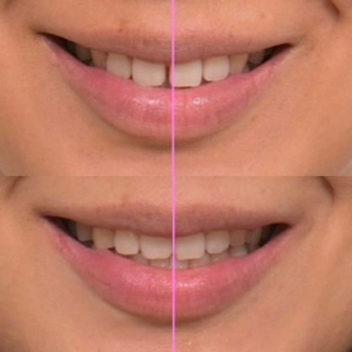 نتائج قبل وبعد التقويم في عيادة Yonsei JW Dental Clinic – تحسين انتظام الأسنان