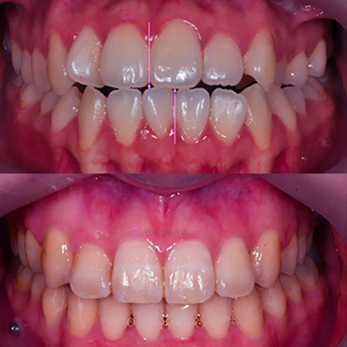 نتائج قبل وبعد تقويم الأسنان في عيادة Yonsei JW – تحسين انتظام الأسنان