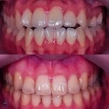 Resultados antes y después de brackets en Yonsei JW Dental Clinic: alineación dental mejorada