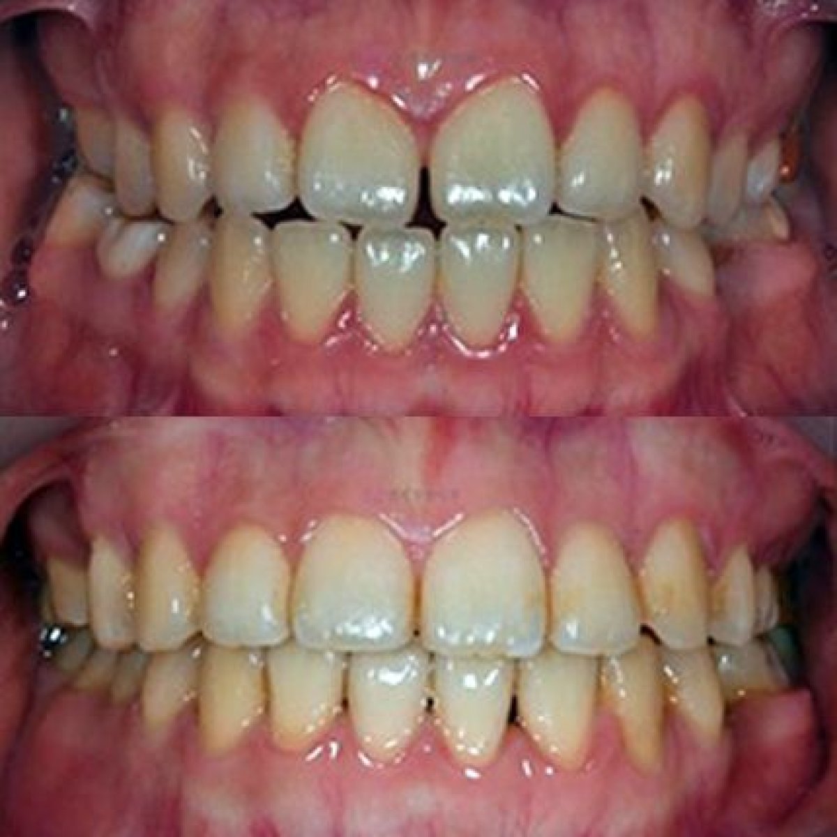 نتائج قبل وبعد تقويم الأسنان في Yonsei JW Dental Clinic، تحسين انتظام الأسنان