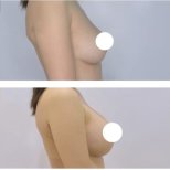 Vorher-nachher-Ergebnis Brustvergrößerung in der Kongju Clinic, mehr Brustvolumen