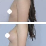 Vorher-nachher-Ergebnis Brustvergrößerung in der Kongju Clinic, mehr Brustvolumen