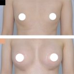 Vorher-nachher-Ergebnis Brustvergrößerung in der Kongju Clinic, mehr Brustvolumen