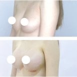 Resultados antes y después de aumento de senos en Kongju Clinic, mayor volumen mamario