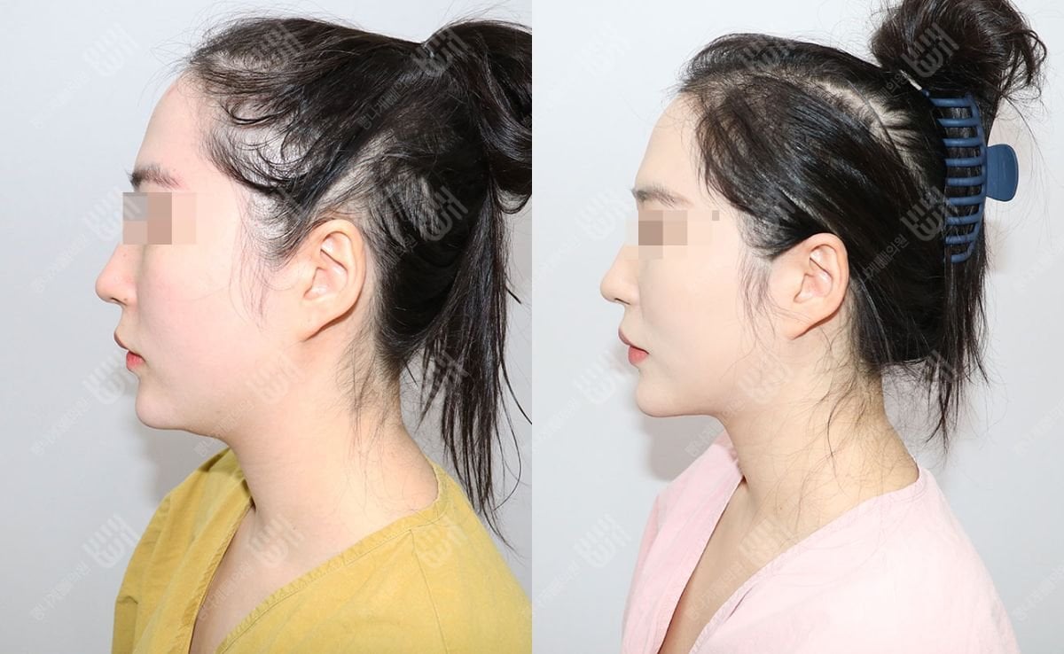 Résultats avant/après lipofilling à la clinique Bbae, contour du visage et menton améliorés