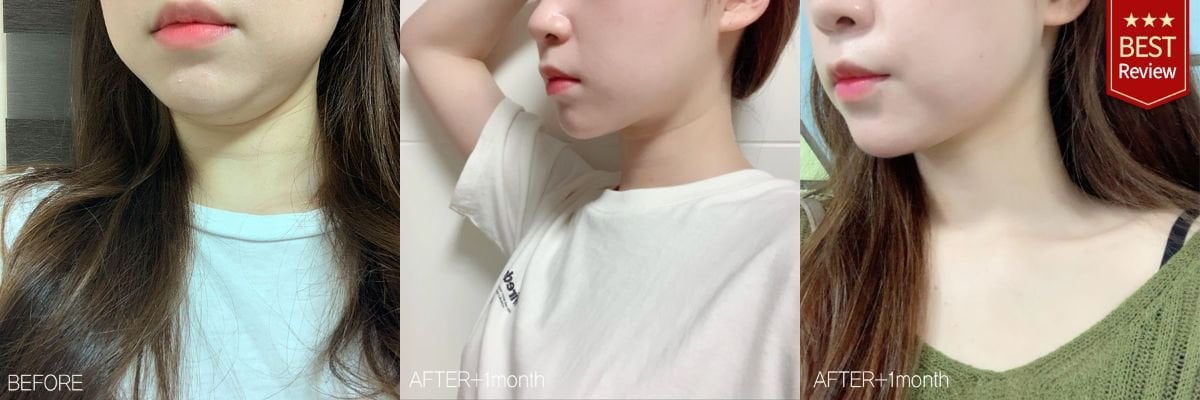 Avant/après lipofilling à la Bbae Clinic – contour du menton et de la mâchoire amélioré