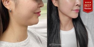 Efekty lipofillingu w Bbae Clinic – poprawiony kontur żuchwy po 1 miesiącu