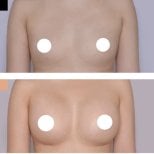 Resultados antes y después de aumento de senos en Kongju Clinic – mayor volumen mamario