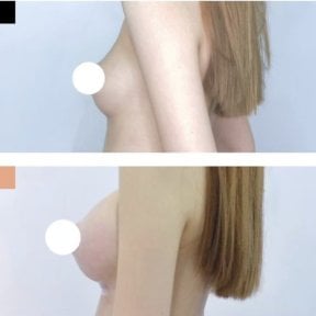 Resultados antes y después de aumento de senos en Kongju Clinic, mayor volumen mamario