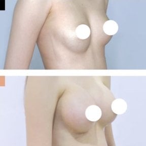Resultados antes y después de aumento de senos en Kongju Clinic, mayor volumen mamario