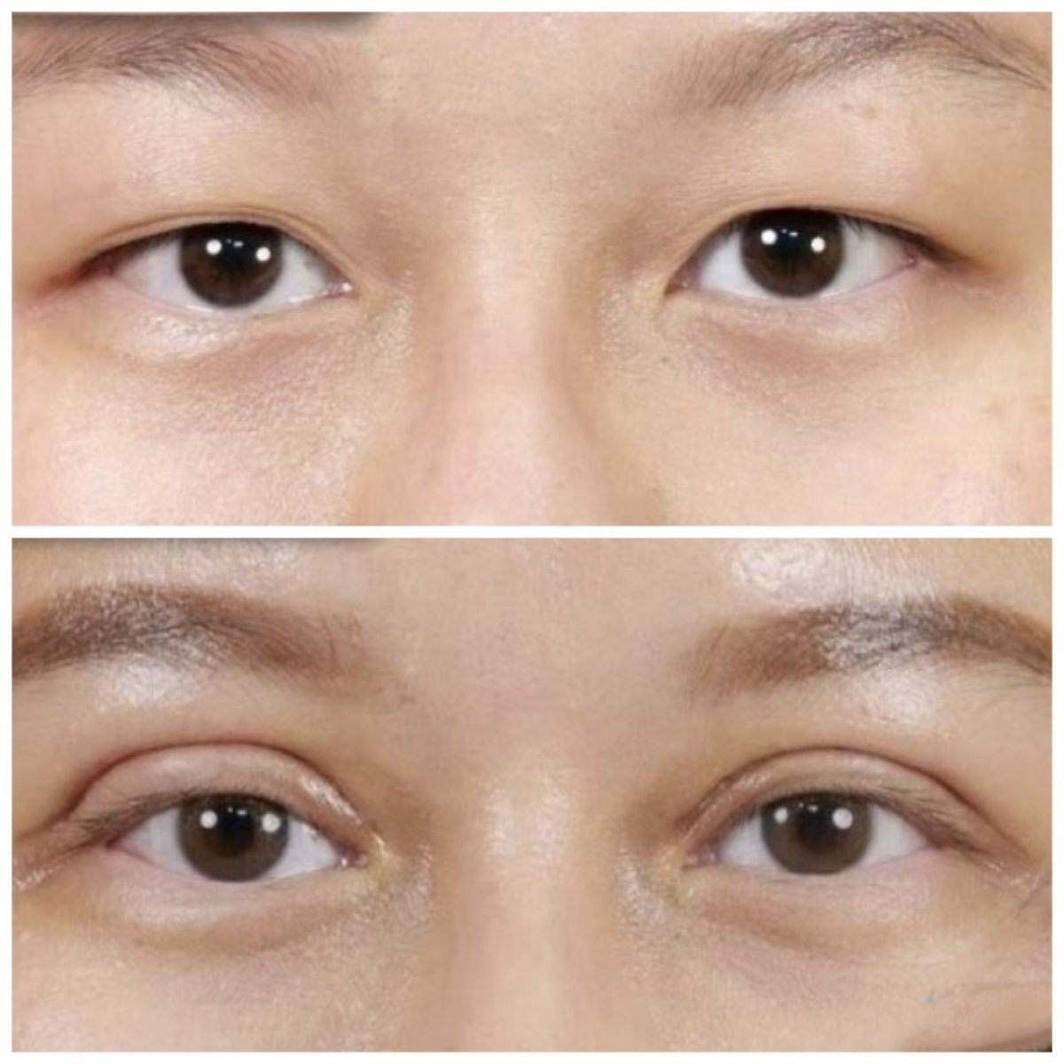 Результаты до и после операции двойного века в клинике Kongju, улучшенная складка века