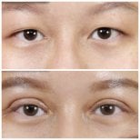 Результаты до и после операции двойного века в клинике Kongju, улучшенная складка века