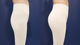 Before and after buttock lift results at HERSHE Plastic Surgery Korea, enhanced contour visible
