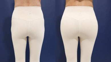 Before and after buttock lift results at HERSHE Plastic Surgery Korea, improved contour visible