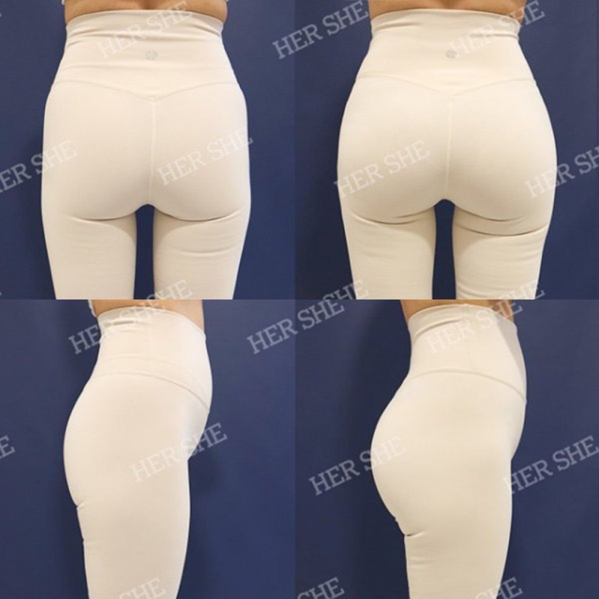 Resultados de lifting de glúteos antes y después en HERSHE Plastic Surgery Korea, contorno mejorado