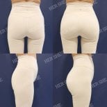 Before and after buttock lift results at HERSHE Plastic Surgery Korea, enhanced contour visible