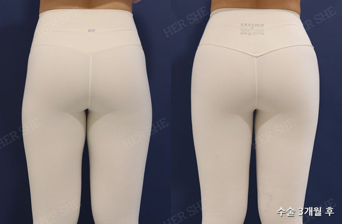 Resultados antes y después de lifting de glúteos en HERSHE Plastic Surgery Korea, contorno mejorado
