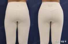 Before and after buttock lift results at HERSHE Plastic Surgery Korea, improved contour visible