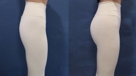 Before and after buttock lift results at HERSHE Plastic Surgery Korea, enhanced contour visible