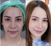 Результаты до и после операции двойного века в клинике Kongju – выразительный взгляд