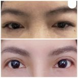 Результаты до и после операции двойного века в клинике Kongju, улучшенный вид глаз