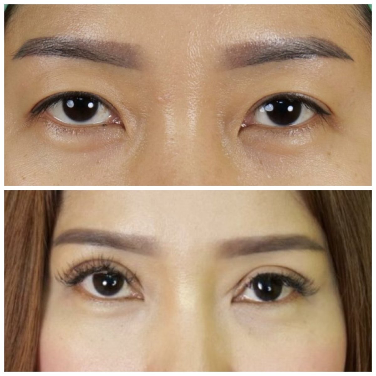 Результаты до и после операции двойного века в клинике Kongju, улучшенная складка века