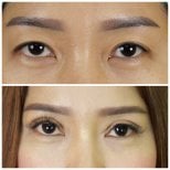 Результаты до и после операции двойного века в клинике Kongju, улучшенная складка века