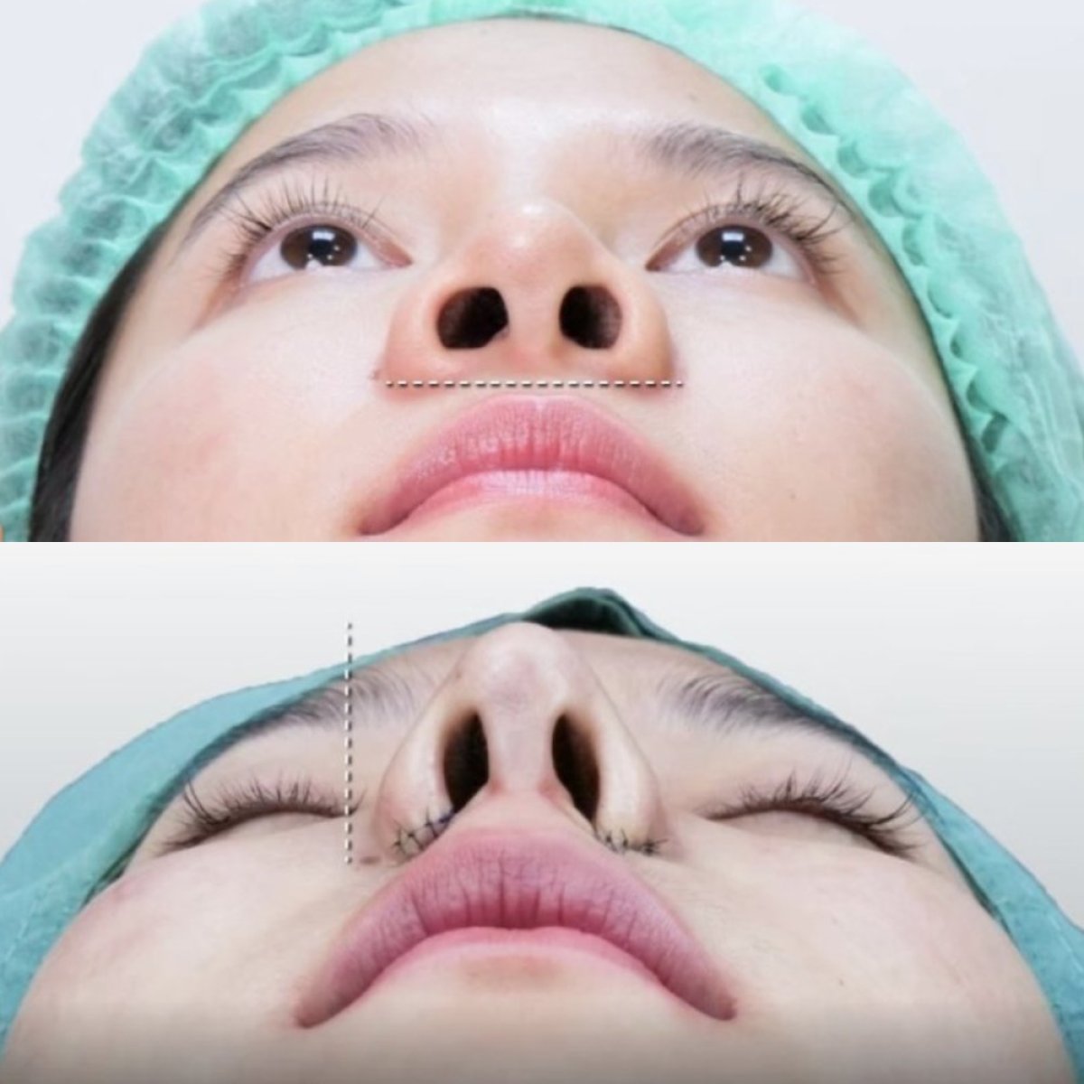 Resultados antes y después de rinoplastia abierta en Kongju Clinic, mejora de forma nasal