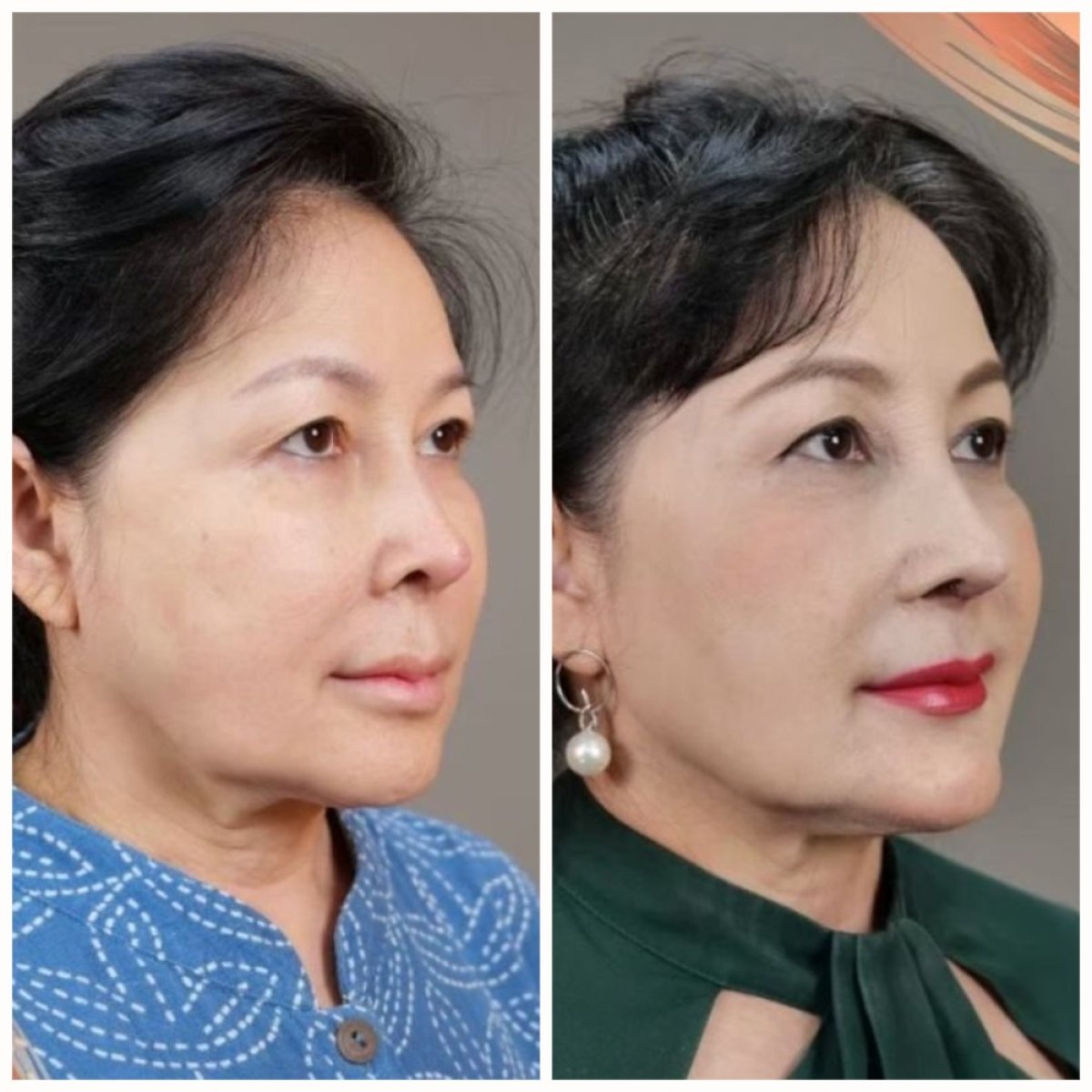 Resultados antes y después de rinoplastia abierta en Kongju Clinic, mejora de la forma nasal